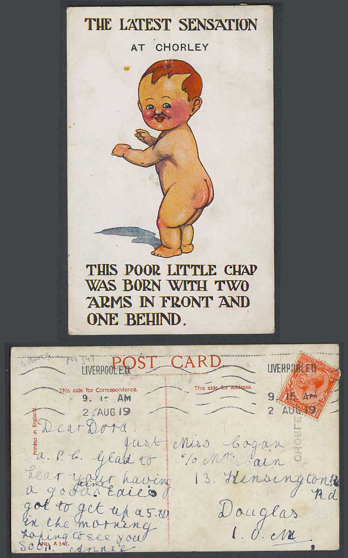 Latest Sensation at Chorley, Boy Born 2 Arms in Front 1 Behind 1919 Old Postcard